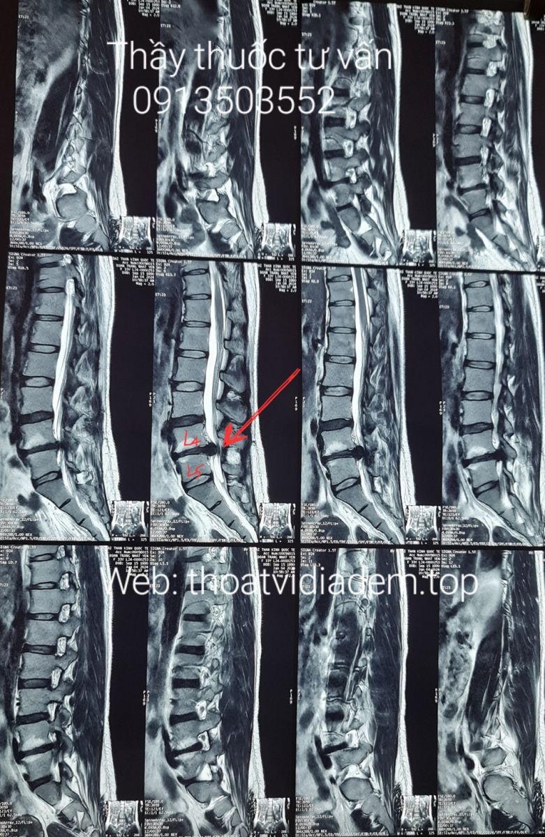 Thoát vị đĩa đệm L4 L5